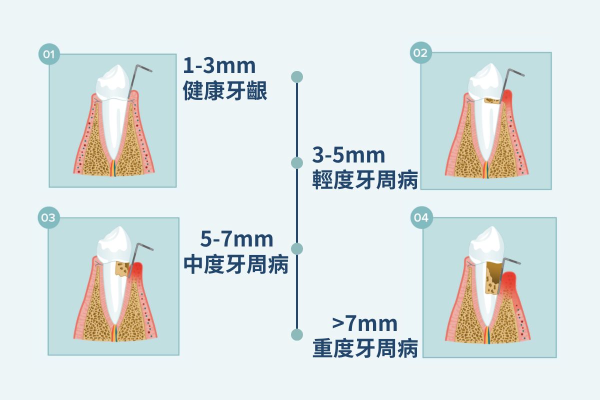 牙周囊袋深度